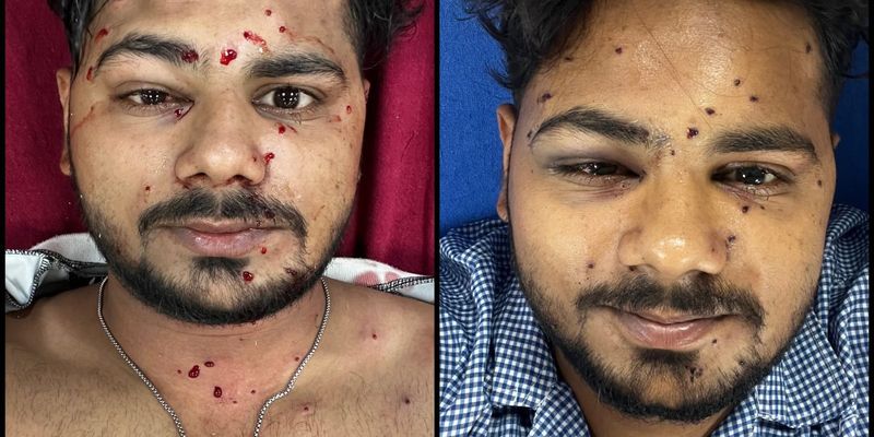 Two Pellet Firing Victims Move Supreme Court Seeking Ban on Metallic Pellet Guns Against Civilians - The Wire