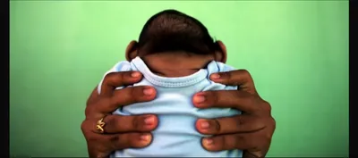 72 babies born with zika related birth defect in angola