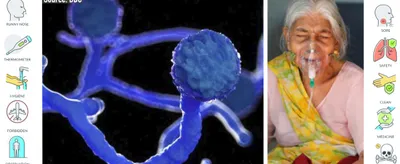 watch   the  black fungus  causing blindness in some covid 19 survivors